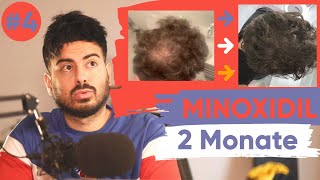 Minoxidil  2 Monate Erfahrung  Haarausfall Analyse [upl. by Ycart814]