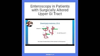 Enteroscopy in Patients with Surgically Altered Upper GI Tract [upl. by Essy528]