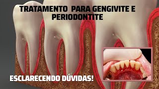 Tratamento para Gengivite e Periodontite  Esclarecendo Dúvidas [upl. by Roose]