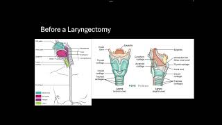 Module 4 Post Laryngectomy [upl. by Ricardama3]