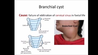 Branchial cyst [upl. by Sofer]