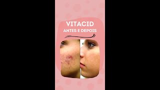 VITACID ANTES E DEPOIS Shorts [upl. by Watters]