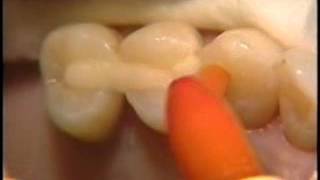 Posterior Periodontal Splint [upl. by Brigitte435]