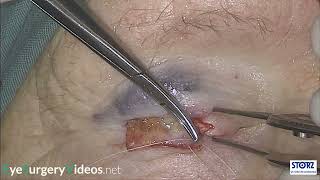 Upper eyelid reconstruction with hard palate mucous membrane graft [upl. by Ellertnom]