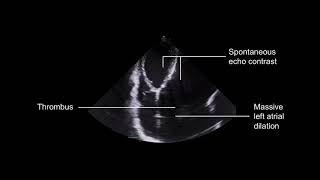 Grading mitral stenosis [upl. by Alletneuq]