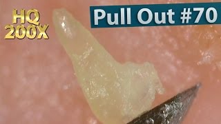 70 Pull Out Blackheads Close up 200X  Blackheads Removal [upl. by Ahsoek]