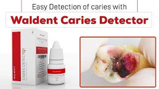 Easy Detection of Caries with Waldent Caries Detector [upl. by Enyawad]