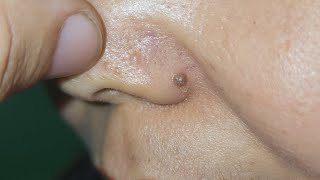 Scarless Co2 Laser Mole Removal [upl. by Conrado]