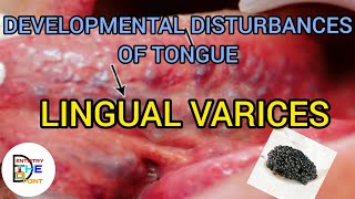 LINGUAL VARICE  LINGUAL VARICOSITY  CAVIAR TONGUE  DEVELOPMENT ANOMALIES OF TONGUE [upl. by Brion]