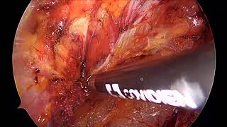 Simultaneous eTEP repair for inguinal hernia with cholecystectomy by Dr Ameya Sanjiv Thakur [upl. by Pirbhai555]