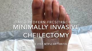 Minimally Invasive Cheilectomy For Hallux Rigidus [upl. by Aretahs]