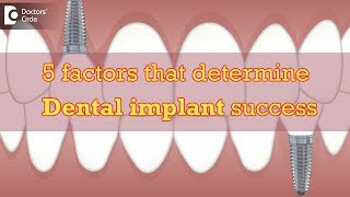 5 factors that determine Dental implant success  Dr Manesh Chandra Sharma [upl. by Ennayk632]