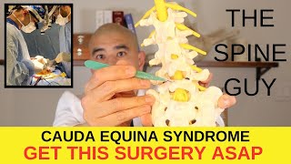 Treatment for Cauda Equina Syndrome [upl. by Ginnifer]