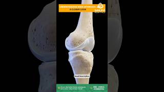 Effective Treatments for Knee Arthrosis Advanced Care at Sanjivi Hospitals [upl. by Zielsdorf]