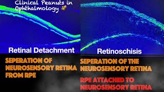 Retinoschisis Vs Retinal Detachment [upl. by Lleda]