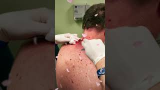 Las Vegas Dermatology Cyst Follow up video 🎥 with incision and drainage procedure 💉 🔪 [upl. by Nelon]