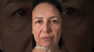 Oculoplastica  Prima e Dopo Ptosis Asimmetria palpebre Blefaroplastica 2 0 [upl. by Millian]