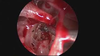 Endoscopic Congenital Stapes Footplate Fixation [upl. by Atile]