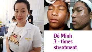 Acne treatment reputation effective at Hien Van Spa375Đỗ Minh3 times [upl. by Celtic640]