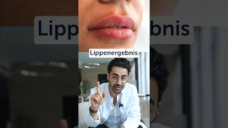 lippenaufbau lippenunterspritzung lippen lippenunterspritzung lips plastischechirurgie [upl. by Rufford893]