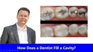 How Does a Dentist Fill a Cavity [upl. by Vittorio]