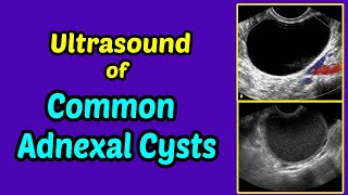 Ultrasound of Common Adnexal Cysts [upl. by Zwiebel555]