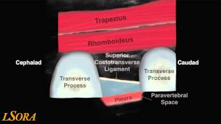 LSORA paravertebral block US guided tutorial [upl. by Eamon]