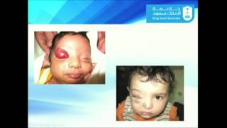 Update in Orbital and Periorbital and Hemangiomas and Vascular Malformation [upl. by Sperling]