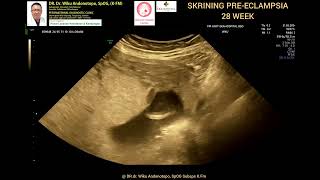 Skrining PreEclampsia 28 weeks [upl. by Elleuqar489]