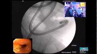 Enteroscopic Balloon Dilation of Multiple Ileal Strictures in Suspected Crohns Disease [upl. by Ardme]