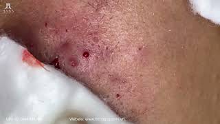 Big Cystic Acne Blackheads Extraction Blackheads amp Milia Whiteheads Removal Pimple Popping [upl. by Oliana]