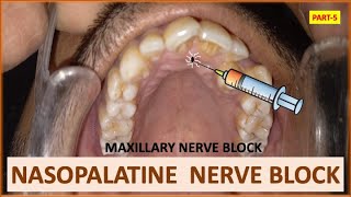 NASOPALATINE NERVE BLOCK PART5 MAXILLARY NERVE BLOCK ORAL SURGERY dentalcafe4331 [upl. by Llertnor]