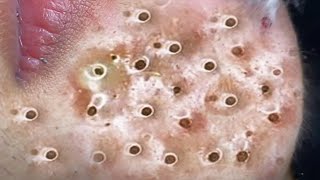 Big Cystic Acne Blackheads Extraction Blackheads amp Milia Whiteheads Removal Pimple Popping  3785 [upl. by Leiahtan601]