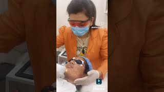 Anti Acne amp Pigmentation treatment Laser treatment [upl. by Mandell619]