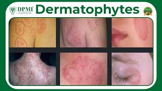 Dermatophyte Infection Types Of Dermatophytes Dermatophyte Symptoms Diagnosis And Treatment [upl. by Otto]