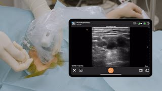 USG Interscalene Block with Catheter [upl. by An926]