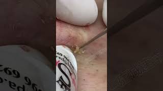 Blackhead Removal Acne Removal Treatment 09 [upl. by Kahler]