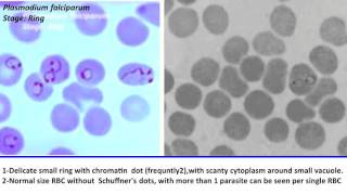 24 Practical Parasitology  Plasmodium Falciparum  Ring Stage [upl. by Leslie]