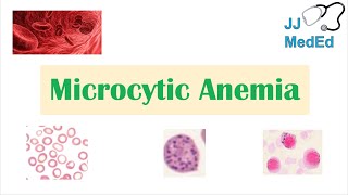 Microcytic Anemia amp Causes Iron Deficiency Thalassemia Anemia of Chronic Disease Lead Poisoning [upl. by Lonna]