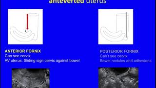 Webinar Replay How to diagnose Endometriosis on Ultrasound [upl. by Akerdal]