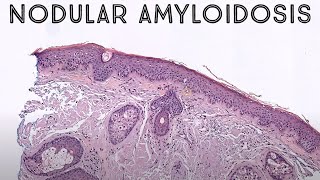 Nodular Amyloidosis AL light chain amyloidosis in skin pathology dermpath dermatology [upl. by Deys796]