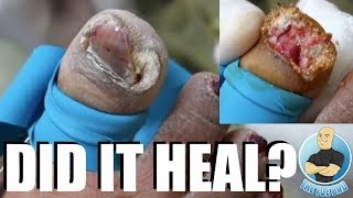 THE CRAZIEST TOENAIL EVER WITH WARTS AND FUNGUS 1 YEAR FOLLOWUP [upl. by Yemac]