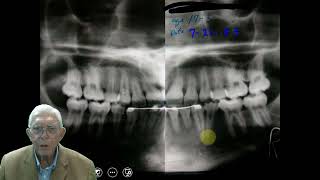 Supernumerary Teeth  Case 1 [upl. by Accem698]