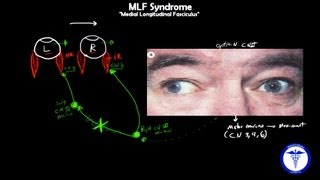 MLF syndrome  Internuclear Ophthalmoplegia MADE EASY [upl. by Saturday504]