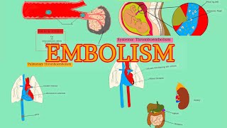 Pathology 18HDD 4  EMBOLISM  Pulmonary thromboembolism  Systemic thromboembolism AfSoomaali [upl. by Eboj]