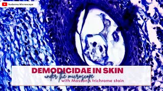 Demodicidae in skin under the microscope with Massons trichrome stain [upl. by Arahsal]