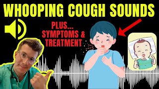 Doctor explains WHOOPING COUGH plus examples of REAL SOUNDS  Symptoms diagnosis treatment amp more [upl. by Sieracki]