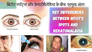 बिटोट स्पॉट्स और केराटोमैलेशिया के बीच अंतरdifferences between Bitots Spots and Keratomalacia [upl. by Hareehahs]