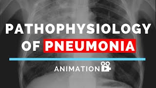 Pathophysiology of Pneumonia  Animation  Made Easy [upl. by Luahs868]