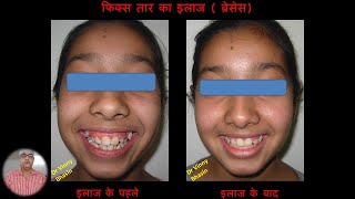 Braces Before and After  Part 4  Orthodontic treatment [upl. by Cleary]